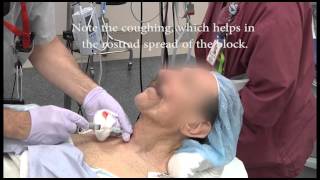 Awake intubation with the Clarus Video System from AOD rerelease [upl. by Hanforrd191]