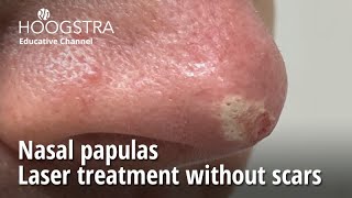 Nasal papulas  Laser treatment without scars  24129 [upl. by Ehlke]