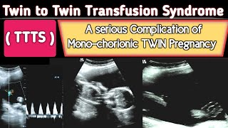 TTTS  Twin to Twin Transfusion Syndrome Ultrasound  A Serious COMPLICATION [upl. by Tarr]