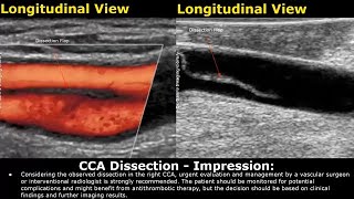 Carotid Artery Doppler Ultrasound Reporting  How To Write USG Report  Stenosis USG Scan Reports [upl. by Jolda738]