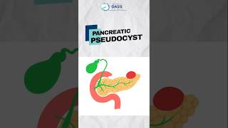 Pancreatic Pseudocyst क्या होता है  Dr Aditya Kulkarni dradityakulkarni pancreaticpseudocyst [upl. by Siger273]