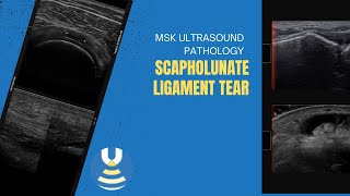 Scapholunate ligament tear on MSK ultrasound [upl. by Acinnad426]