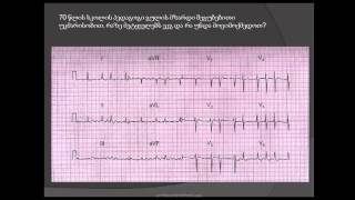 ეკგ წინაგულების ფიბრილაცია წინაგულების ციმციმი მოციმციმე არითმია [upl. by Namzzaj]