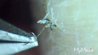 pLuCkInG Ingrown Hair in Satisfying Compilation [upl. by Michaud]