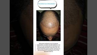 Finasteride for hair loss in androgenic alopecia [upl. by Terrene]