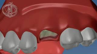 Dental implant procedure first molar [upl. by Ancilin519]