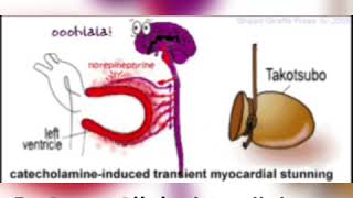 Takotsubo Cardiomyopathy  Animation [upl. by Nosneh]