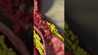 Heart Blockage💥 Angioplasty Explained in 30 Seconds ⏰quot [upl. by Calvo]