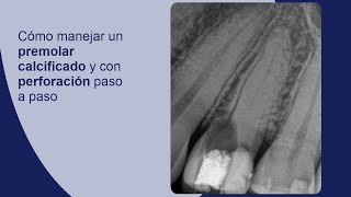 Cómo manejar un premolar calcificado y con perforación paso a paso [upl. by Ssecnirp]