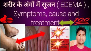 Edema शरीर के अंगों में सूजन  EDEMA  Symptoms cause and treatment  Abhia2zmedical [upl. by Ihsakat489]