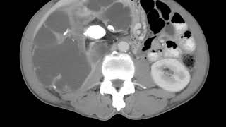 GU C1 Xanthogranulomatous Pyelonephritis [upl. by Airbmak]