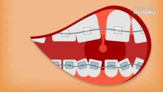 Porque ha cambiado la ortodoncia [upl. by Etnuhs]