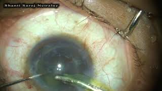 Posterior subcapsular cataract with 3 piece sensar IOL [upl. by Ainola]