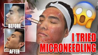 Before and After 3 Microneedling Sessions [upl. by Ainivad161]