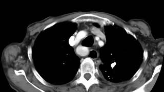 Retrosternal goitre Ahuja AT et al 2017 Book Essential Radiology [upl. by Ynogoham]