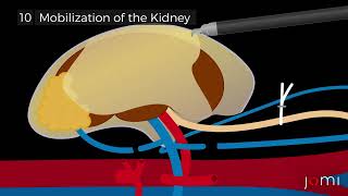 Step by Step  RoboticAssisted Laparoscopic Left Donor Nephrectomy for Living Kidney Donation [upl. by Narad298]