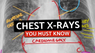 10 MUST KNOW Chest XRays For MedicalPA Finals  CXRs Made Easy [upl. by Nivar]