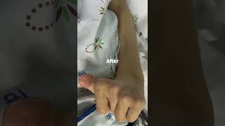 Cerebral palsy tremor of forearm wrist hand was stopped immediately [upl. by Narda]