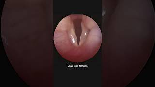 Vocal Cord Implant [upl. by Philomena328]