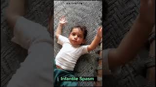 Infantile Spasm fits seizures infantilespasm epilepsy treatment [upl. by Rorke542]