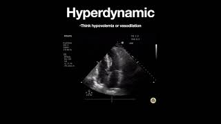 Hyperdynamic Left Ventricle Apical [upl. by Marentic]