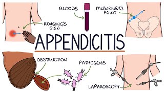 Understanding Appendicitis [upl. by Deibel]