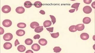 Hematology Clinical Case  1 Anemia amp Size of Cell by MedicAids [upl. by Onibas]