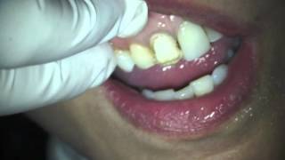 Dr Harvey Shiffman Fotona Lightwalker Dental Laser Veneer Removal [upl. by Abrams]