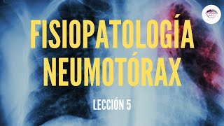 5 FISIOPATOLOGÍA NEUMOTÓRAX FISIOPATOLOGÍA RESPIRATORIA [upl. by Aesoh77]