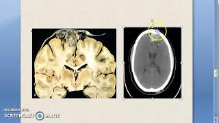 Pathology 899 a Meningioma Tumor IntraCranial Merlin NeuroFibromatosis Arachnoid Meninges [upl. by Naz]