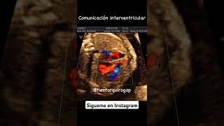 Comunicación interventricular [upl. by Norabel]