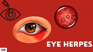 Eye Herpes Causes Signs and Symptoms Diagnosis and Treatment [upl. by Port]