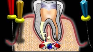Komplikace pri osetreni zubniho korene [upl. by Nishom]