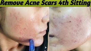 Reduce Acne Scars Day By Day  Before amp After Skin  Part4 acnescars chikenpoxscarsremove [upl. by Nohshan205]