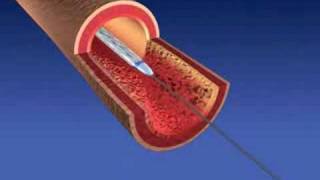 Balloon Angioplasty and Stent Implantaion [upl. by Greenman]