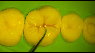 Upper First Molar Composite Restoration Cusp by Cusp buildup technique [upl. by Atarman921]