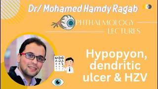 Cornea 2 Hypopyon dendritic ulcer amp HZV [upl. by Haldan]