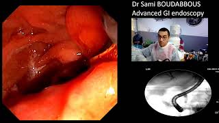 ERCP FOR PANVREATIC HEAD CANCER [upl. by Everara]