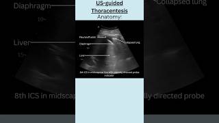 USguided Thoracentesispleuraleffusion thoracentesisUltrasoundguidance [upl. by Sema930]