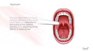 Snoring and Sleep Apnea Treatment with NightLase® [upl. by Kimberlyn928]