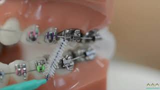 How to use interdental brushes on braces  Evolution Orthodontics [upl. by Elazaro]