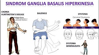 Video 53 Sindrom Ganglia Basalis Hiperkinesia [upl. by Einallem829]