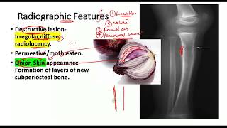 Ewing Sarcoma  EVERYTHING you need to know [upl. by Nisen]