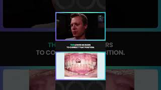 Using Aligners to Achieve a Successful Implant 🦷 [upl. by Hughett]