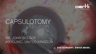 Surgery Video Capsulotomy by John Bolger [upl. by Litsyrk615]