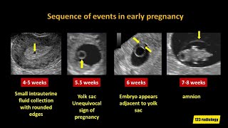 Early Pregnancy Failure A simplified Ultrasound Approach [upl. by Willing468]