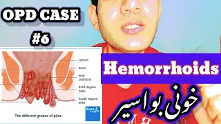 Hemorrhiods ❤️ General OPD CASE 6❤️ hemorrhoids piles بواسیر Treatment medication [upl. by Mohorva]