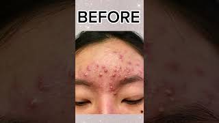 Accutane Acne Treatment by Dr Shafa dermatology dermatologist acne accutane youtubeshorts [upl. by Tlihcox]