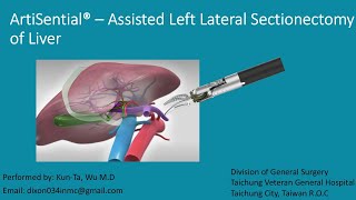 Artisential  assisted Left Lateral Sectionectomy [upl. by Eilegna]