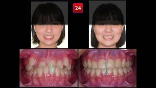 Nonextraction Treatment of Pseudo Class III malocclusion｜【Chris Chang Ortho】CC706 [upl. by Dayir]